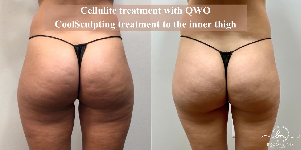 Introducing QWO at Brooke Nix Medical Aesthetics • Maryville & Knoxville TN  • 865.333.0186