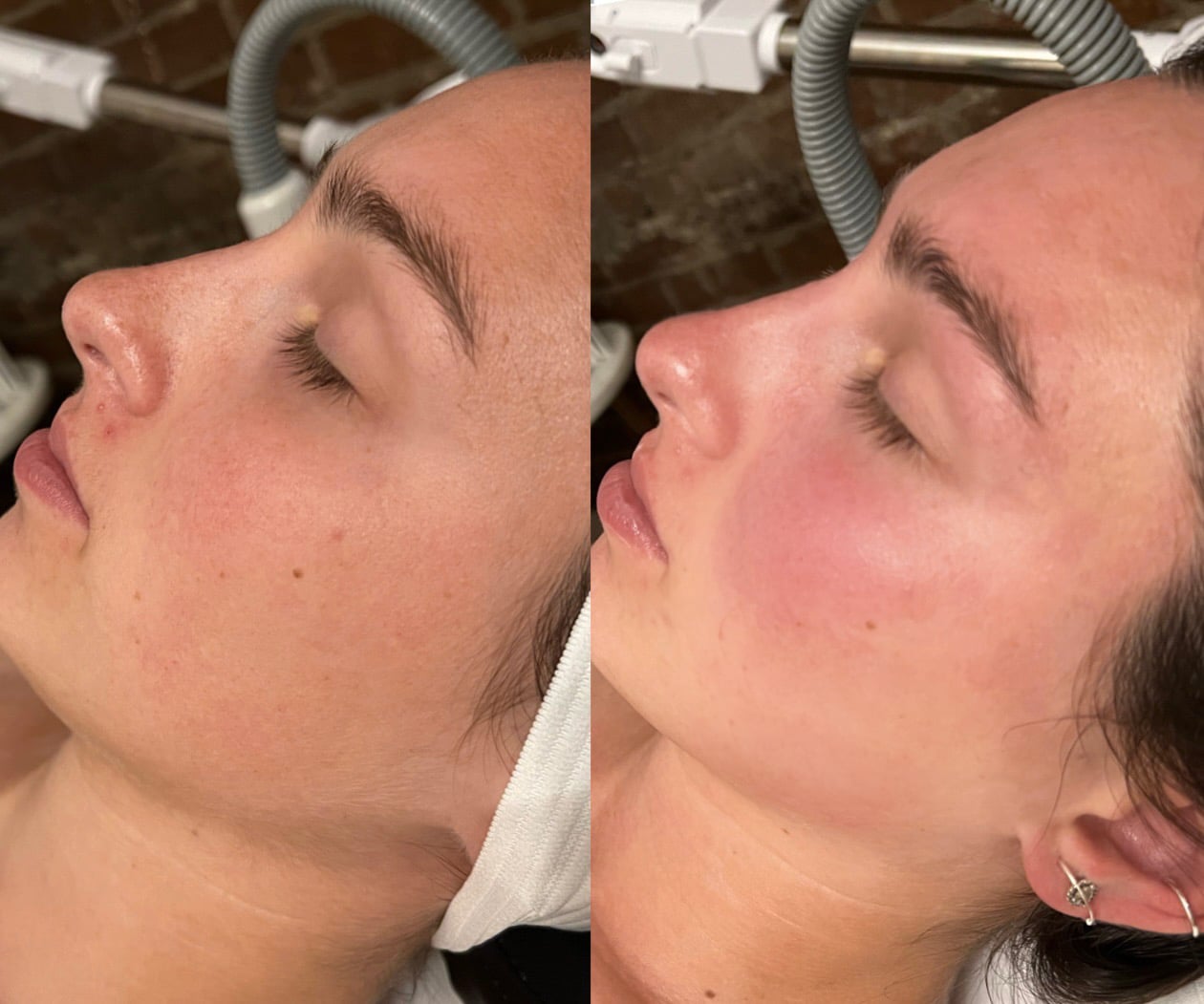 Glow On The Go With Diamond Glow Brooke Nix Medical Aesthetics 865