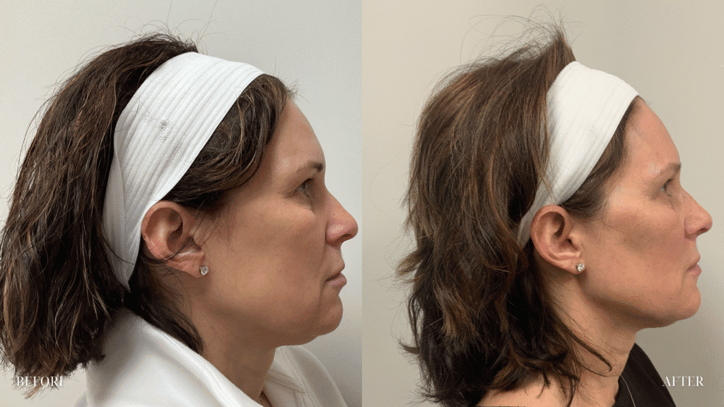 Aesthetic profile of a woman before and after facial rejuvenation or aesthetic treatment at Brooke Nix Medical Aesthetics.