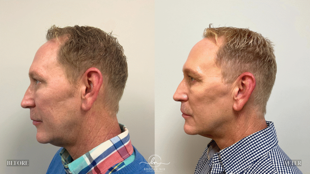 Red-haired man before and after facial rejuvenation, showcasing improved skin texture and youthful appearance through non-surgical aesthetic treatments at Brooke Nix Medical Aesthetics.